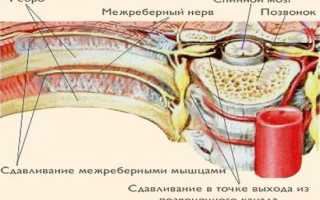 Межреберная невралгия — что это такое, симптомы и лечение в домашних условиях