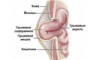 Послеоперационная вентральная грыжа операция — Всё о лечении грыжи