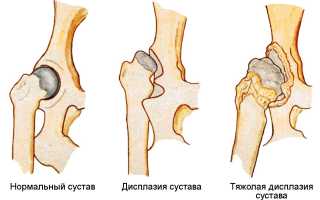 Основные принципы ЛФК при дисплазии тазобедренных суставов у новорожденных