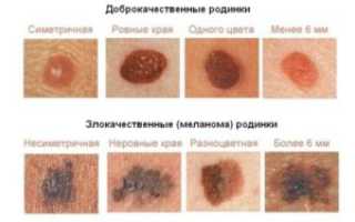 Опасно ли удалять родинки на лице