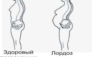 Лордоз лечение