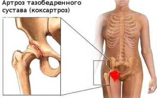 Лечение коксартроза народными средствами в домашних условиях