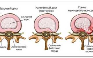 Карипазим при грыже позвоночника: отзывы и нюансы применения!