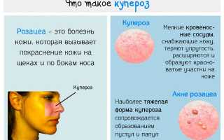 Пилинг лица при куперозе
