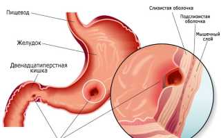 Боль в грудине посередине (в грудной клетке) – причины. Боль за грудиной посередине – что делать?