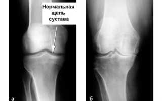 Почему болит колено при ходьбе в районе чашечки что делать и чем лечить