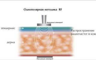 Радиолифтинг лица последствия