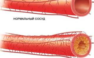 Эпилепсия у взрослых: симптомы и причины возникновения