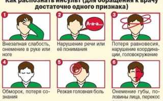 Аплазия правой позвоночной артерии что это такое