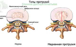 Дорзальная медиальная грыжа диска l4 l5