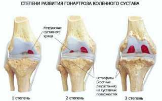 Упражнения при гонартрозе коленного сустава 1, 2 и 3 степени, лечебная гимнастика в домашних условиях