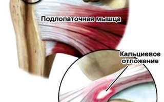 Шейный остеохондроз и плечелопаточный периартрит