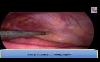 Паховая Грыжа У Мужчин: Операция Сколько Длится
