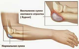 Бурсит локтевого сустава, лечение в домашних условиях