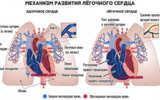 Лёгочная гипертензия: что это такое и сколько с этим живут, как лечить
