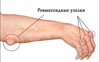 Препараты для лечения ревматизма