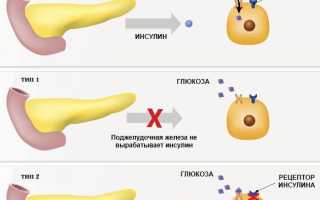 Лечение невропатии нижних конечностей