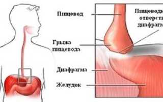 Грыжа пищевода диафрагмы симптомы и лечение