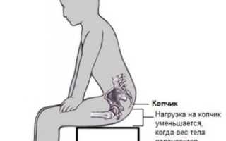 Почему болит копчик когда встаешь со стула