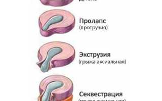 Грыжа в грудном отделе позвоночника симптомы