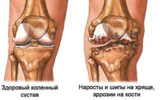 Краевые остеофиты коленного сустава: что это такое, диагностика и лечение