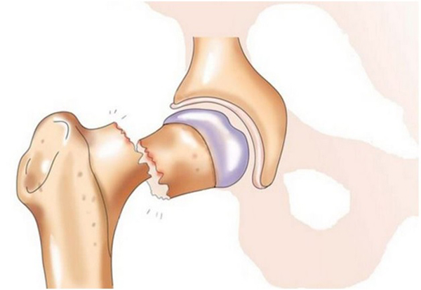 Болит спина при переломе шейки бедра