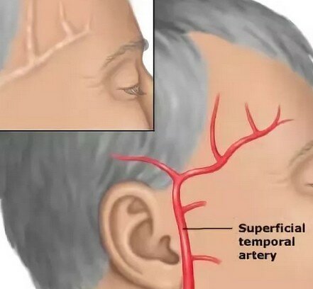 Почему болит голова правая сторона виска