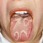 Желтый язык и болит голова