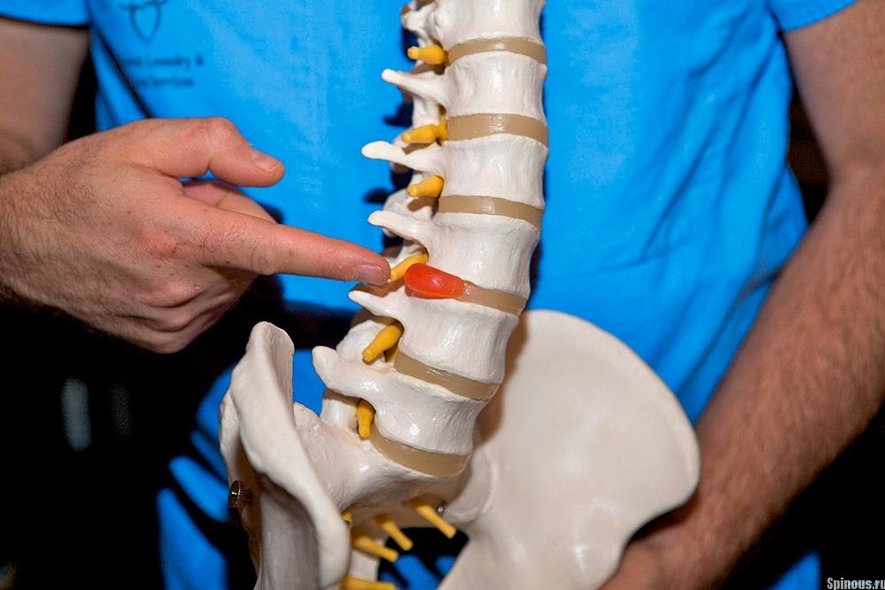 Межпозвоночная грыжа Межпозвоночная грыжа