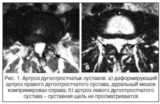 Рис. 1. Артроз дугоотростчатых суставов: а) деформирующий артроз правого дугоотростчатого сустава, дуральный мешок компримирован справа; б) артроз левого дугоотростчатого сустава – суставная щель не просматривается Рис. 1. Артроз дугоотростчатых суставов: а) деформирующий артроз правого дугоотростчатого сустава, дуральный мешок компримирован справа; б) артроз левого дугоотростчатого сустава – суставная щель не просматривается