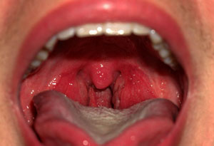 Ангина Воспаление горла