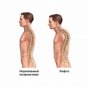 Что делать при хрусте в лопатках