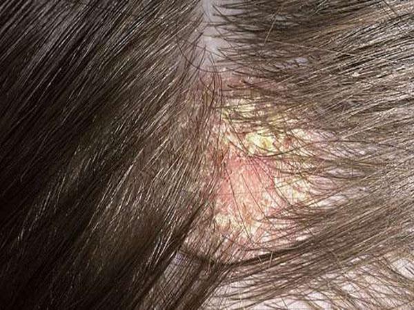 Болит красное пятно на коже головы