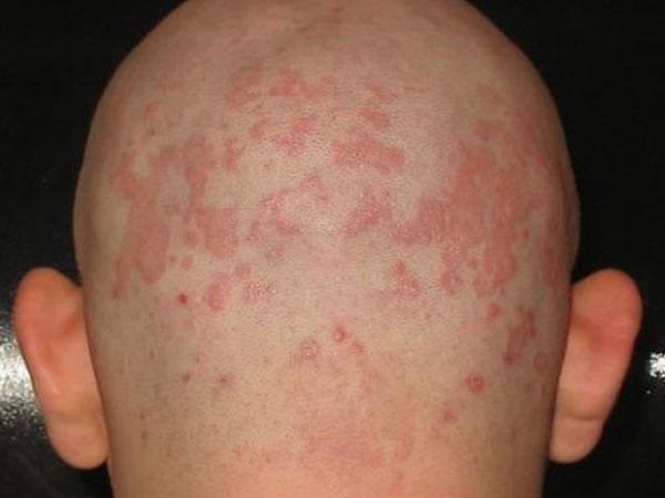 Болит красное пятно на коже головы