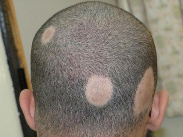 Болит красное пятно на коже головы