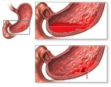 если болит спина в области чуть ниже лопаток