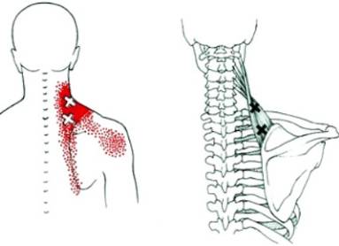 если болит спина в области чуть ниже лопаток