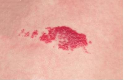 если болит спина в области чуть ниже лопаток