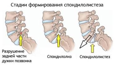 Болит спина в поясничном отделе при наклоне