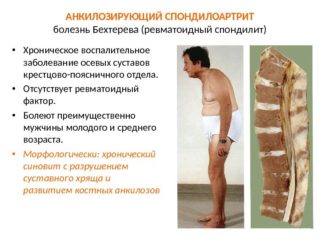 По утрам болит спина и ноги