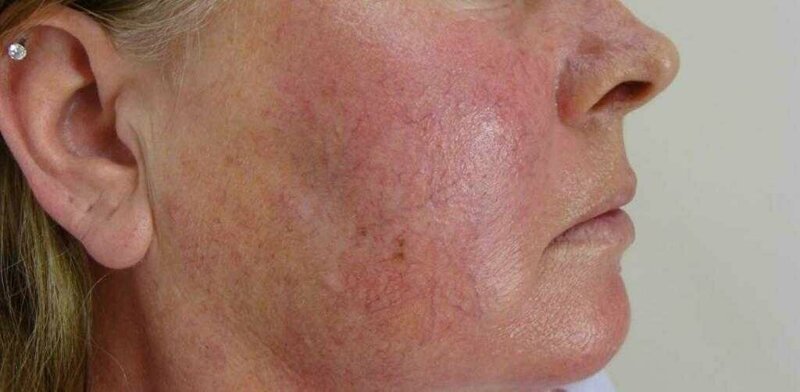 Заболевания, при которых горит лицо Заболевания, при которых горит лицо