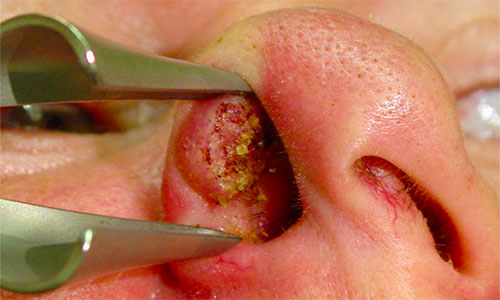 Герпетическая сыпь в носу