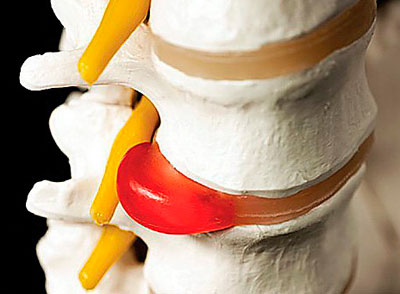 Межпозвонковая грыжа