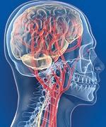 Микроинсульт Микроинсульт