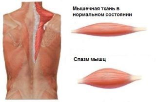 Сколько колоть мовалис от болей в спине