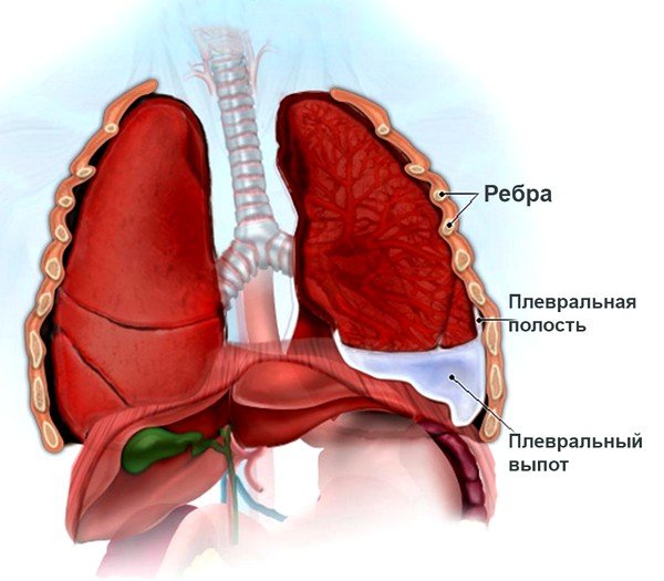 При плеврите возможны боли в боку при кашле При плеврите возможны боли в боку при кашле
