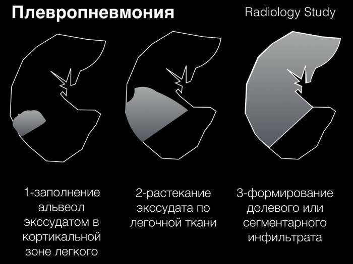 Плевропневмония