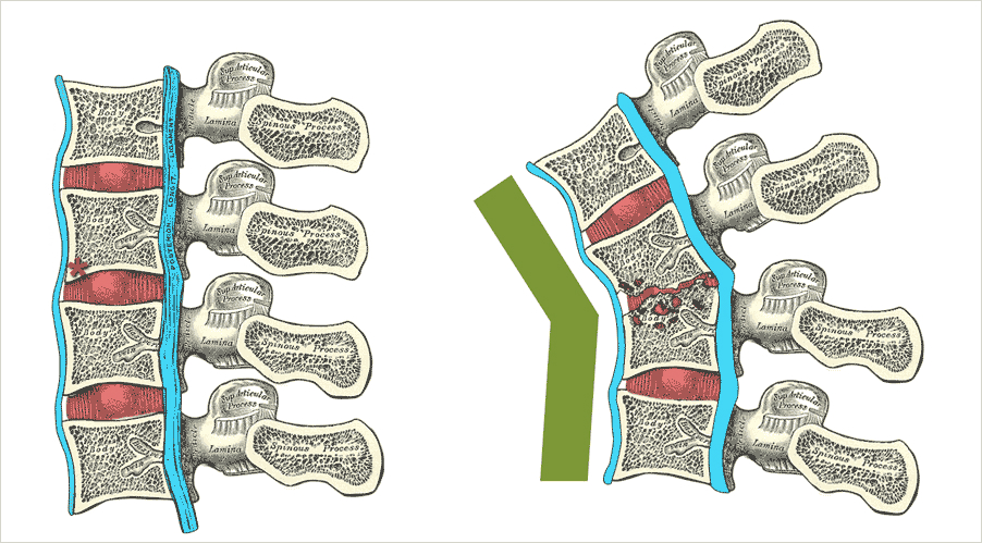 Туберкулез позвоночника