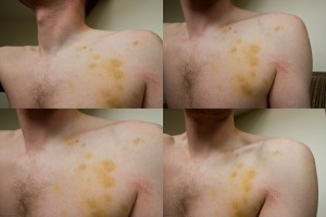 ушиб сердца экг